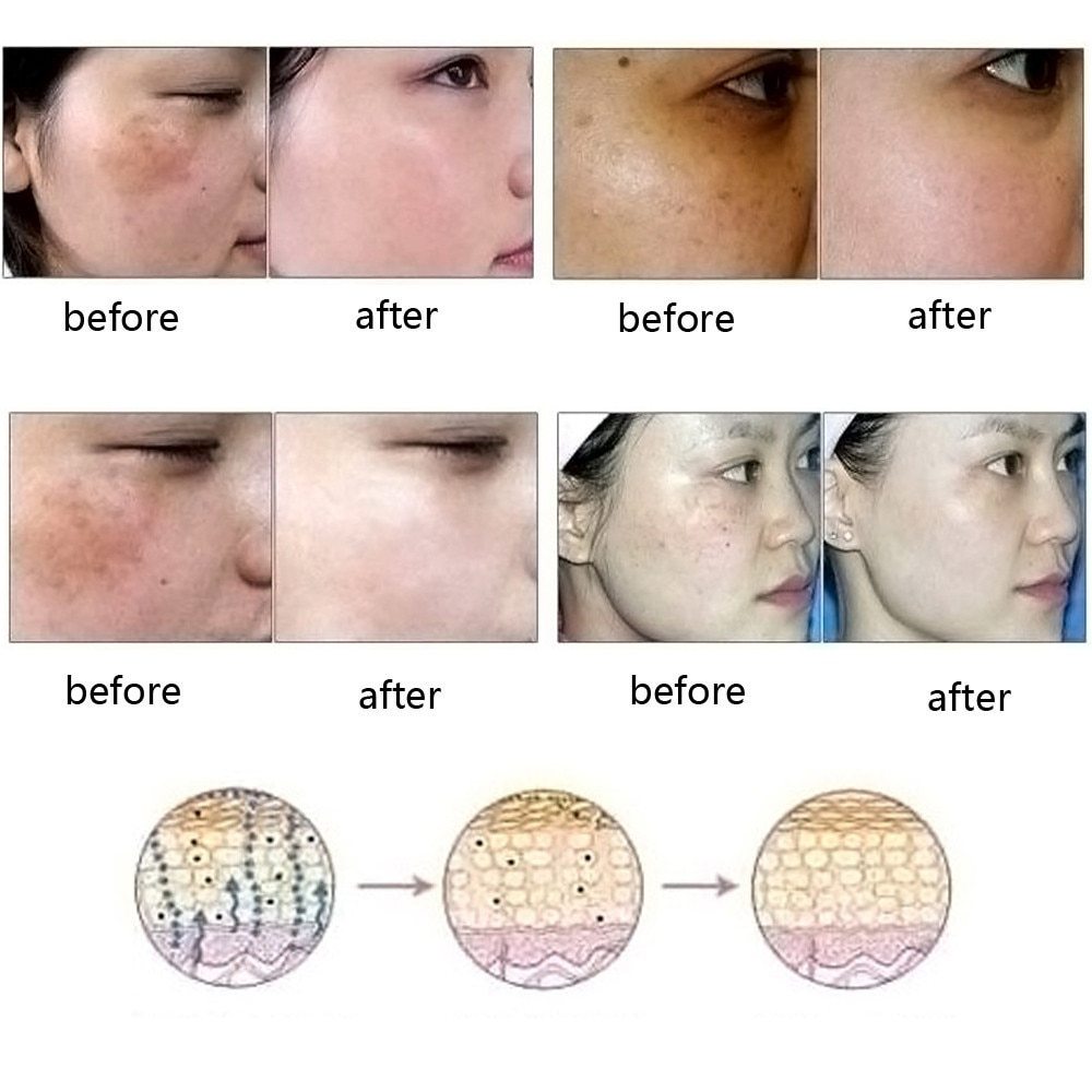 Dredge Meridian Skin Care Natural Pure Removal Acne Stretch Marks Scar Removal Essence oil - 𝓢𝓱𝓸𝓹𝓵𝓮𝓬𝔂