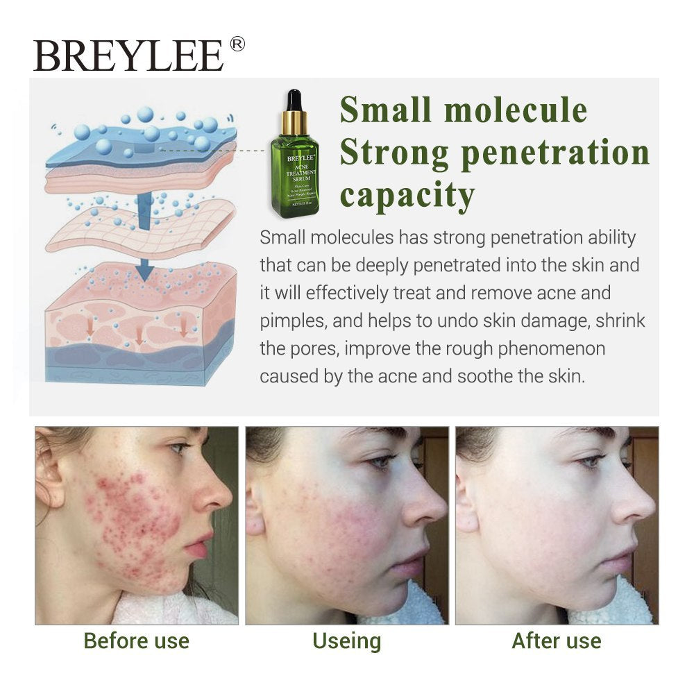 BREYLEE Acne Treatment Serum Face Facial Anti Acne Scar Removal Cream Skin Care Whitening Repair Pimple Remover For Acne - 𝓢𝓱𝓸𝓹𝓵𝓮𝓬𝔂