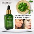 BREYLEE Acne Treatment Serum Face Facial Anti Acne Scar Removal Cream Skin Care Whitening Repair Pimple Remover For Acne - 𝓢𝓱𝓸𝓹𝓵𝓮𝓬𝔂
