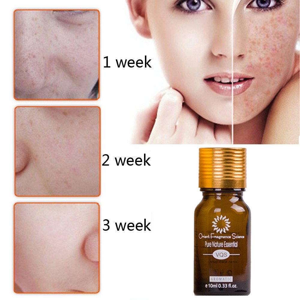 Dredge Meridian Skin Care Natural Pure Removal Acne Stretch Marks Scar Removal Essence oil - 𝓢𝓱𝓸𝓹𝓵𝓮𝓬𝔂