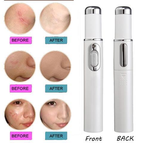 Blue Light Therapy Acne Laser Pen Soft Scar Wrinkle Removal Treatment Device Skin Care Beauty Equipment - 𝓢𝓱𝓸𝓹𝓵𝓮𝓬𝔂